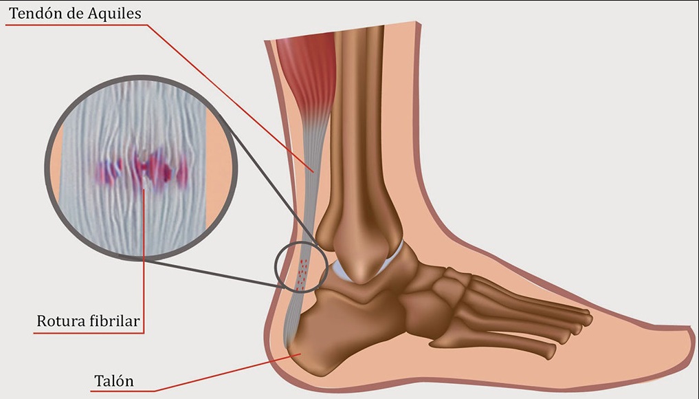 La lesión del tendón de aquiles es una de las más temidas por los jugadores de fútbol.